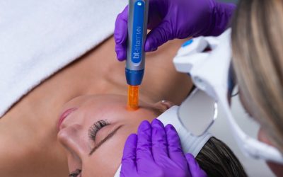 Nano Tip Microneedling versus Microneedling