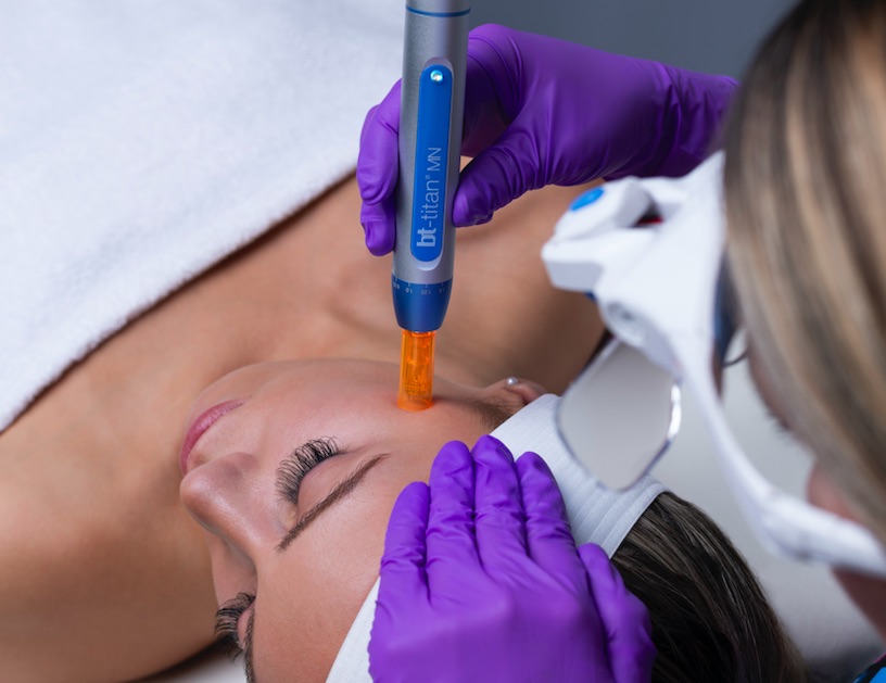 Nano Tip Microneedling versus Microneedling